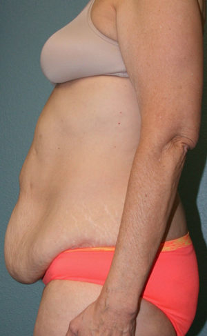 Tummy Tuck