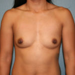 Breast Augmentation