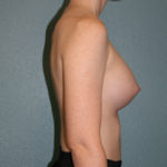 Breast Augmentation