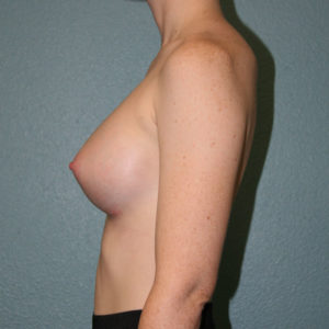 Breast Augmentation