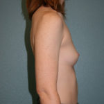 Breast Augmentation