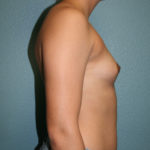 Gummy Bear Breast Implants