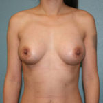 Breast Augmentation