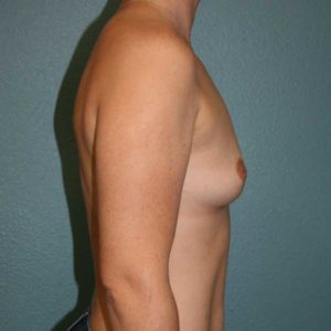 Breast Augmentation