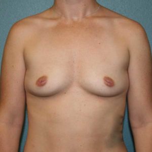 Breast Augmentation