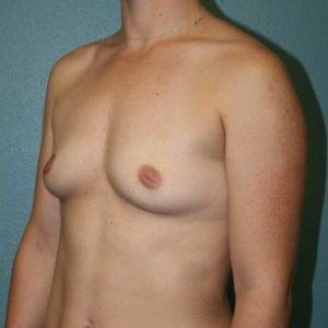 Breast Augmentation