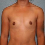 Breast Augmentation
