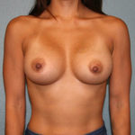 Breast Augmentation