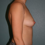 Breast Augmentation