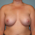 Breast Augmentation