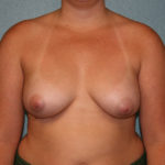 Breast Augmentation