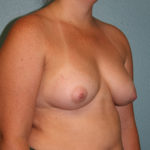 Ideal Breast Implants