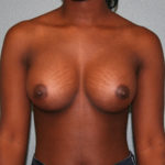 Breast Augmentation