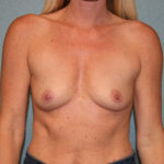 Breast Augmentation