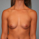 Ideal Breast Implants