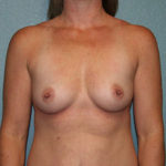 Breast Augmentation