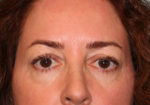 Eyelid Surgery