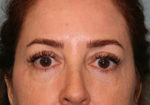 Eyelid Surgery