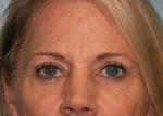 Eyelid Surgery