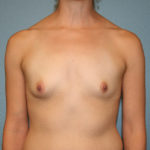 Gummy Bear Breast Implants
