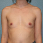 Breast Augmentation