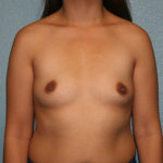 Breast Augmentation