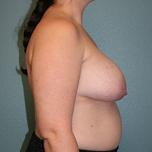 Breast Implant Removal