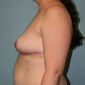 Breast Implant Removal