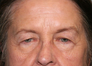 Eyelid Surgery