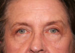 Eyelid Surgery