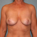 Breast Implant Removal