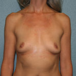 Breast Implant Removal
