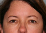 Eyelid Surgery