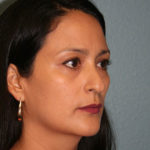 Nose Surgery (Rhinoplasty)