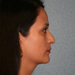 Nose Surgery (Rhinoplasty)