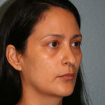 Nose Surgery (Rhinoplasty)