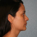 Nose Surgery (Rhinoplasty)