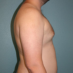 Male Breast Reduction