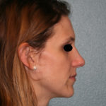 Nose Surgery (Rhinoplasty)