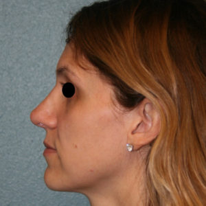 Nose Surgery (Rhinoplasty)