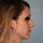 Nose Surgery (Rhinoplasty)