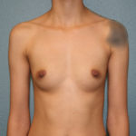 Breast Augmentation