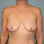 Breast Augmentation