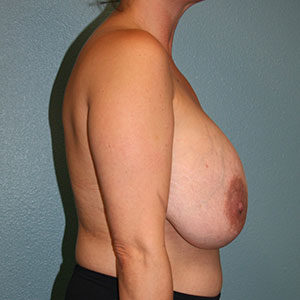 Breast Implant Removal