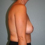 Breast Implant Removal