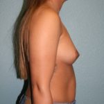 Breast Augmentation