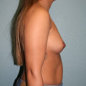 Breast Augmentation