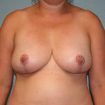 Breast Reduction