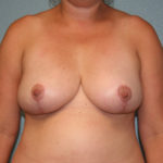 Breast Reduction