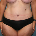 Tummy Tuck